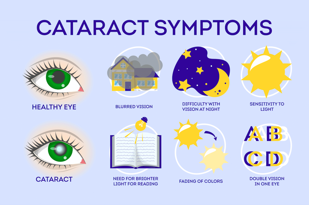cataract surgery symptoms in Singapore