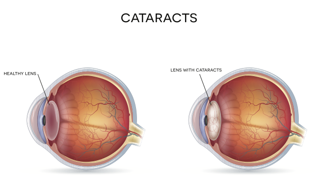 cataract surgery and procedure in Singapore